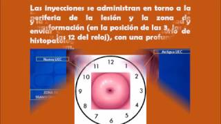 Conización cervical Betania Especialidades Médicas [upl. by Isyed]