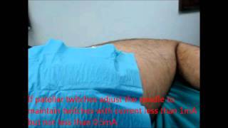 posterior lumbar plexus block nerve stimulationwmv [upl. by Nomyar]