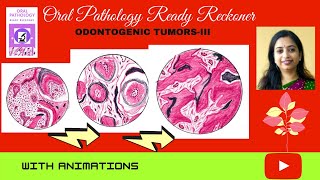 Odontogenic Tumors III Odontogenic FibromaMyxomaAmeloblastic FibromaOdontomeOdontoma [upl. by Champaigne]