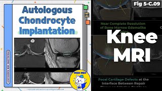 Fig 5C09 MRI Findings of Autologous Chondrocyte Implantation [upl. by Eledoya]