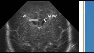 ventricular measurements on neonatal head ultrasound [upl. by Bouley478]