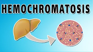 Hemochromatosis [upl. by Bentlee]