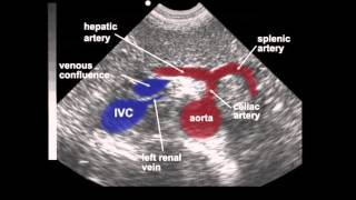 Abdominal Aortic Aneurysm AAA Ultrasound [upl. by Eitra]