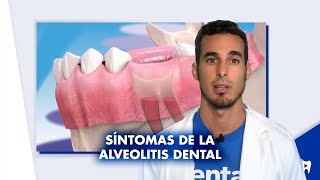 TRATAMIENTO de la ALVEOLITIS y SÍNTOMAS de la infección tras extracción de muela  Shorts [upl. by Laehpar]