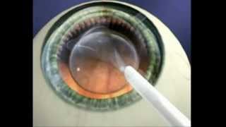 Explication Chirurgie refractive ICL Implant intraoculaire [upl. by Modestia]