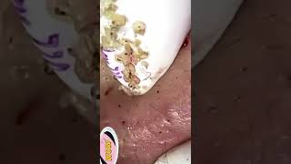 Blackhead Removal Acne Removal Treatment 05 [upl. by Bullough]