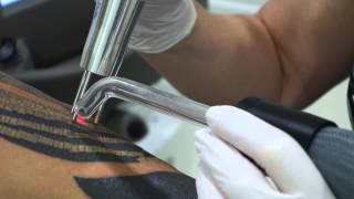 Laser Tattoo Removal  Lenzie Clinic [upl. by Killam]