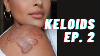 My Keloid Journey  Ep 2  Treatments amp Scar Camouflage at The Basma Hameed Clinic Toronto [upl. by Oiramat]