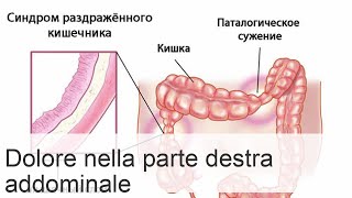 Dolore nel lato destro in basso delladdome negli uomini cause diagnosi e trattamento [upl. by Osmo]