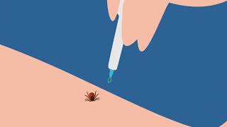 How to properly remove a tick from skin [upl. by Akin]