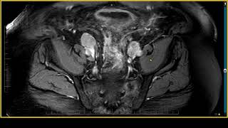 PI RADS 5 Case Review on MRI [upl. by Anotyal59]