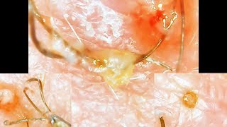 Ingrown Pili Multigemini Blackhead COMBO Very Unique and Satisfying [upl. by Diad]