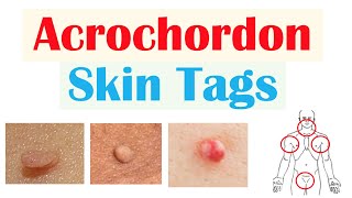 Skin Tags Acrochordons  Causes Risk Factors Symptoms Diagnosis Treatment [upl. by Veradis561]