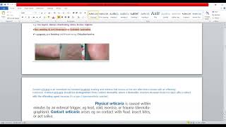 Plab 1 Lectures Dermatology Part 4 Guttate PsoriasisUrticaria [upl. by Sussi163]