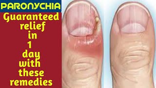 Paronychia finger home remedies  Paronychia fungal nail infection  Paronychia nail home remedies [upl. by Ilysa]