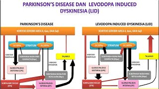 Video 52 Parkinsons Disease dan Levodopa Induced Dyskinesia LID [upl. by Erving]