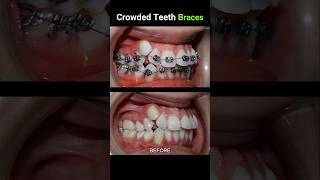 40 months for this braces Crowded teeth braces orthodontist dentist dentistry [upl. by Aneleiram655]