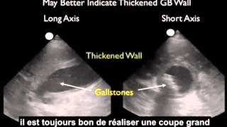 Comment  Réaliser une échographie de la vésicule biliaire  Partie 3  Cholécystite [upl. by Akenna]