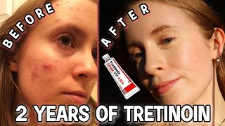 2 YEAR TRETINOIN UPDATE Before amp After Tretinoin Cream 005  My Current Skincare Routine [upl. by Pogue41]