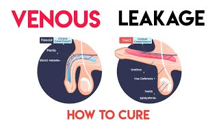 Venous leakage Treatment [upl. by Rosalba]