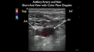 How To Axillary Vein Cannulation  Sonosite Ultrasoundmp4 [upl. by Muscolo]