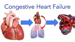 Congestive Heart Failure CHF Explained  MADE EASY [upl. by Halimeda]